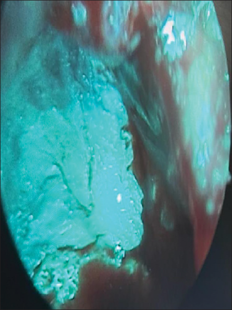 Cholesteatoma flakes seen in the posterior sac of external auditory canal intra operatively after mastoid drilling.